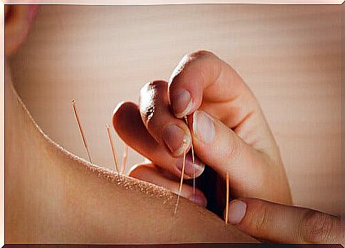 Acupuncture to relieve back pain