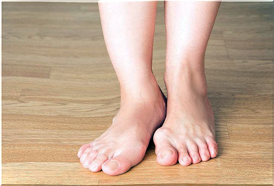 5 tips to prevent the appearance of bunions