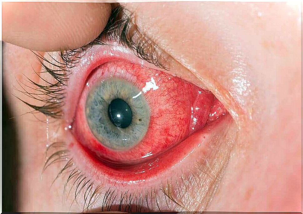 Conjunctivitis