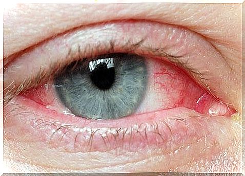 Irritated Eyes - Natural Tips for This Problem