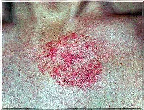 Dermatitis skin