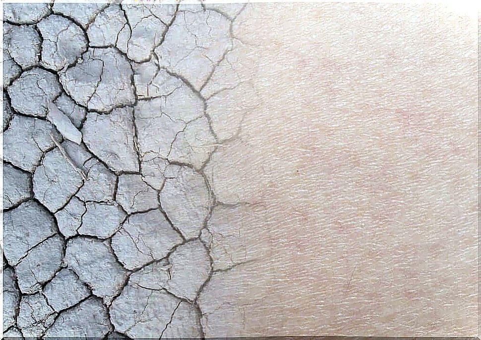 Dry skin