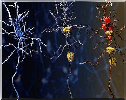 Synapse in Alzheimer's Stages