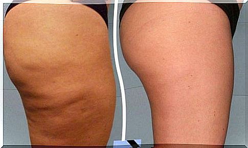 Easy-to-do anti-cellulite treatments at home