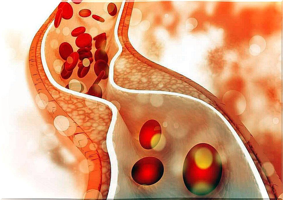 Cholesterol plaques clogging the vein