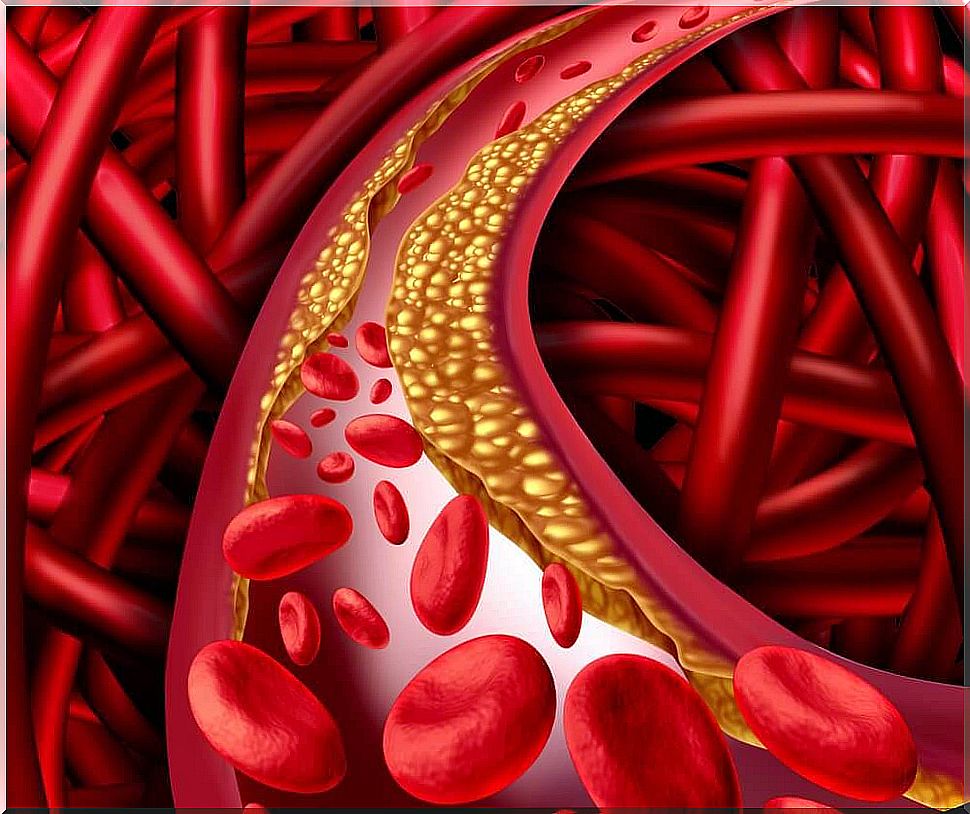 Cholesterol in arteries