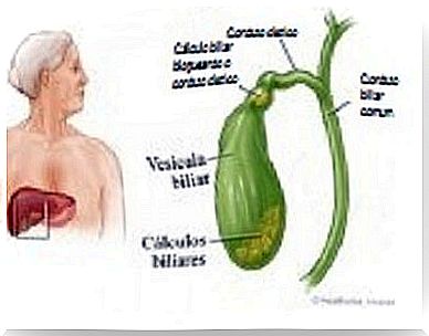 How do I know if I have gallstones?