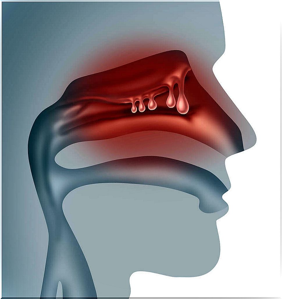 How To Cure Nasal Polyps With 5 Homemade Solutions