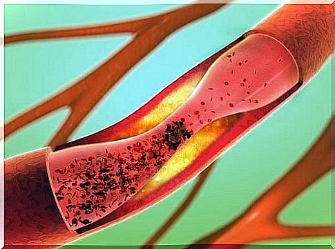 Cholesterol in the veins can trigger a stroke