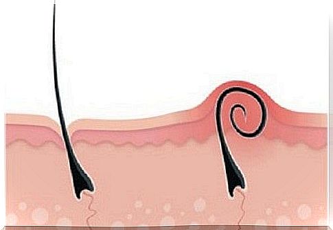 How to prevent and treat ingrown hairs?