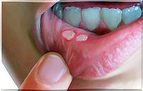 How to treat mouth sores with home remedies