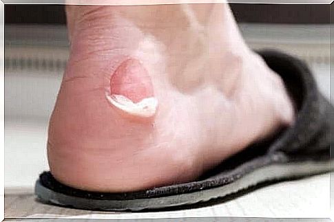 blister on foot