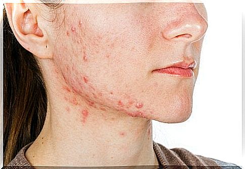 Tretinoin: indications and uses