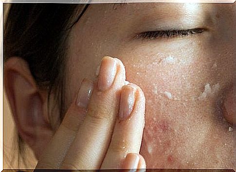 Tretinoin is indicated for skin with acne