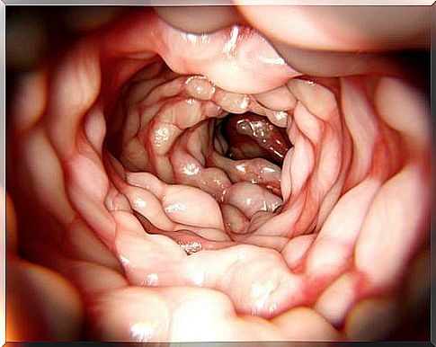 colonoscopy image