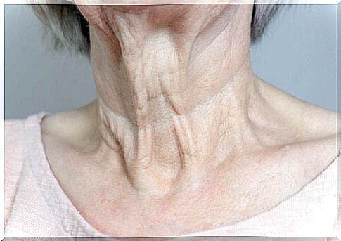 Wrinkles in the neck