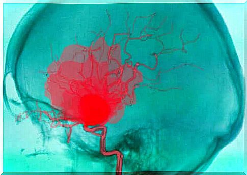 What is a cerebral hemorrhage and why can it occur?