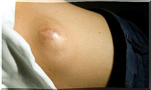 Lipoma in the abdomen