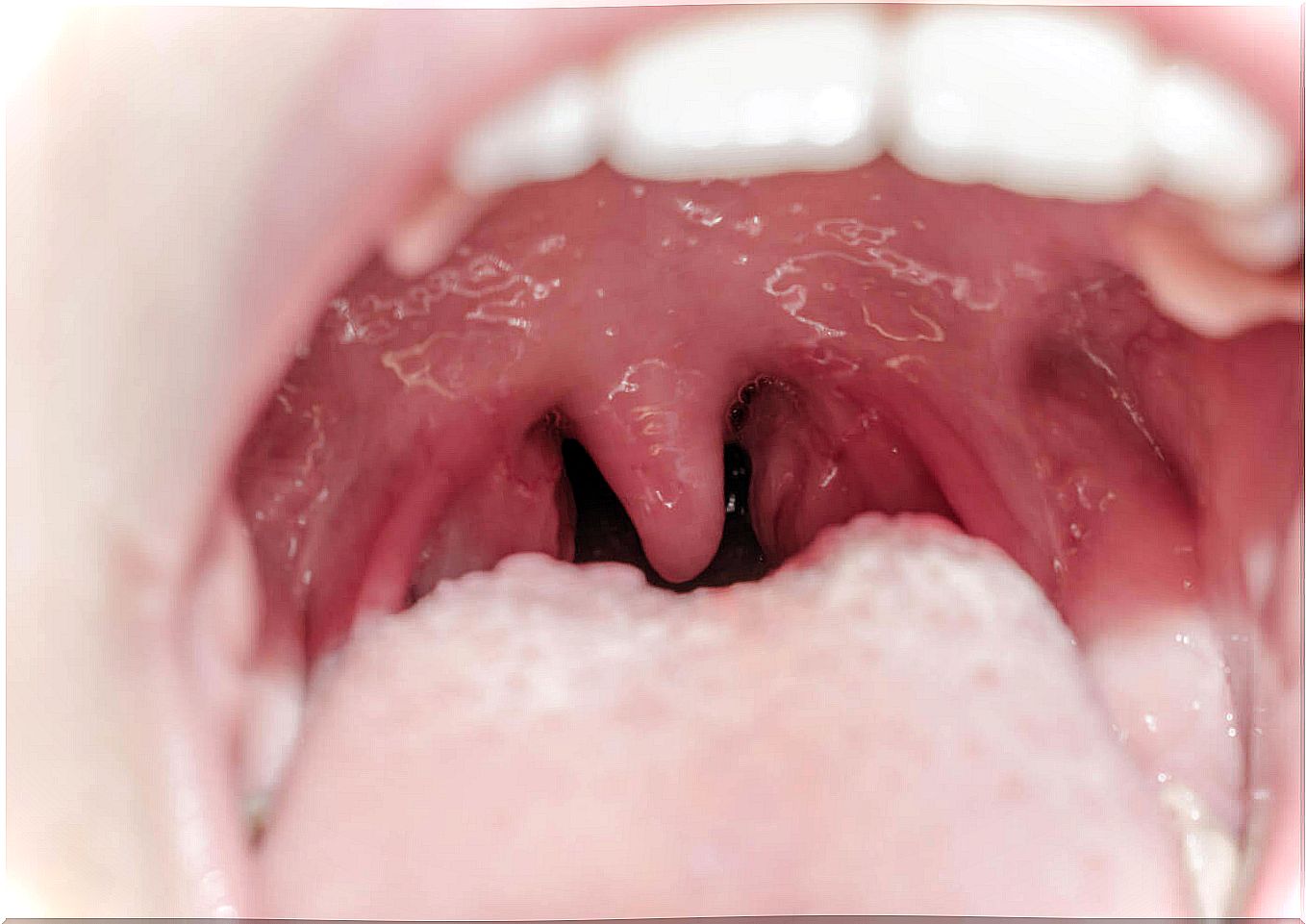 Uvulitis treatment